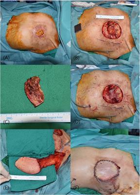 Case Report: Vertical muscle-sparing latissimus dorsi flap in the reconstruction of chronic radiation-induced chest wall ulcers after breast cancer surgery: a case series